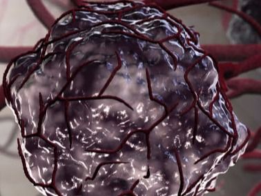 Representación de un tumor irrigado por vasos sanguíneos