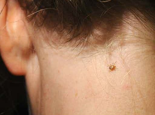 Garrapata sobre la piel del cuello de una persona