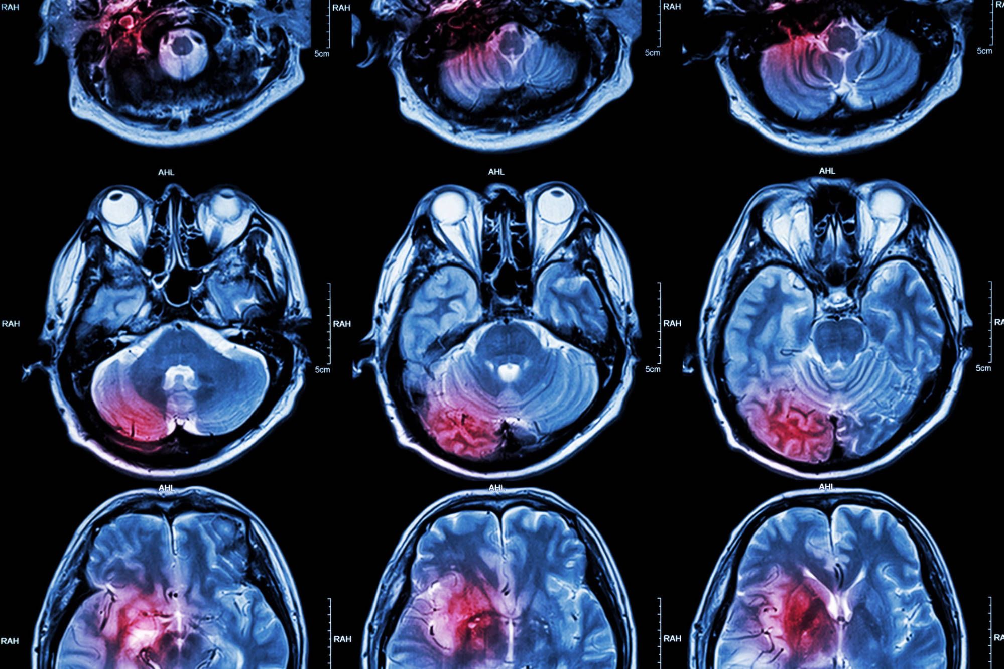 Resonancias magnéticas del cerebro