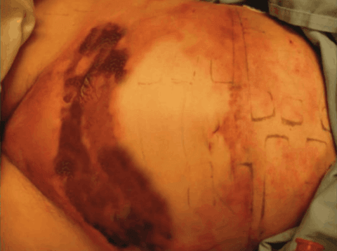 Imagen del artículo «Medicina hiperbárica en medicina estética y cirugía plástica»