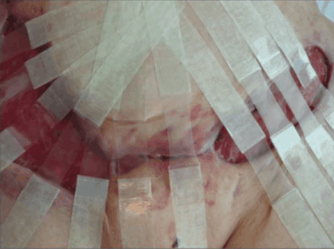 Imagen del artículo «Medicina hiperbárica en medicina estética y cirugía plástica»